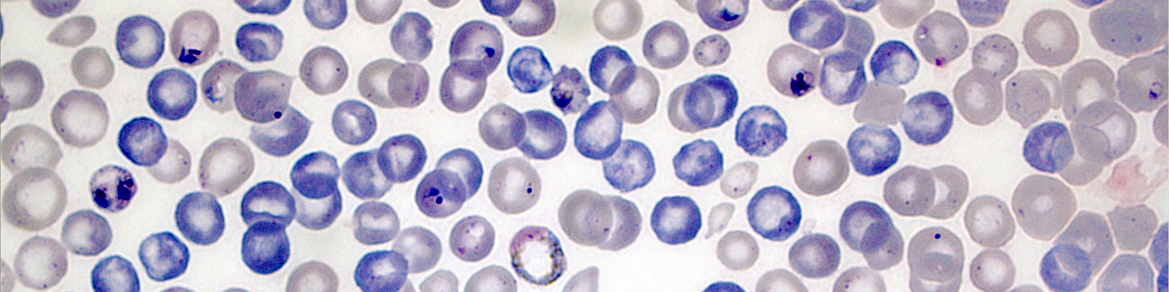 Microscopic image of malaria infected blood cells in purple and blue colours