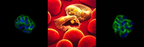 Collage of 3 images of microscopic cells, showing blood cells infected with malaria